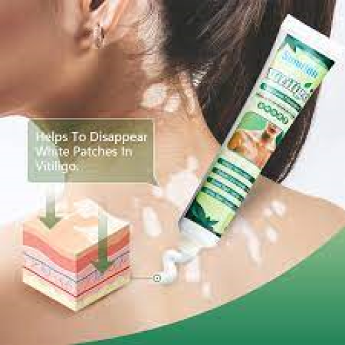 Sumifun New Vitiligo Treatment Ointment Best Product