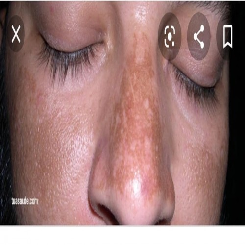 P vita anti melasma cream