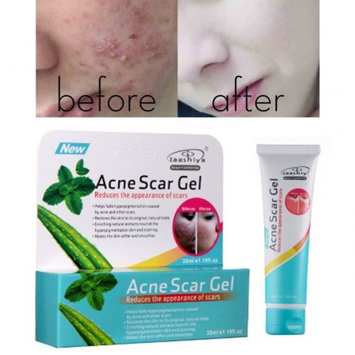 Acne Scar Gel