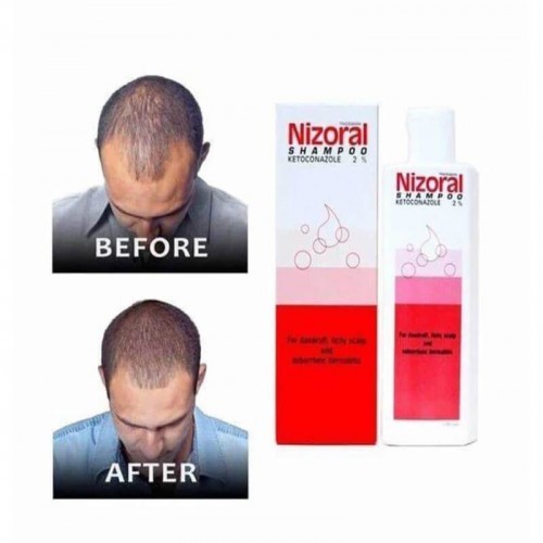 Nizoral Shampoo -100 ml