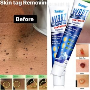 Wart-Remover-Ointment-best-product-1